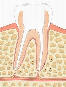 抜髄・根管内の除菌