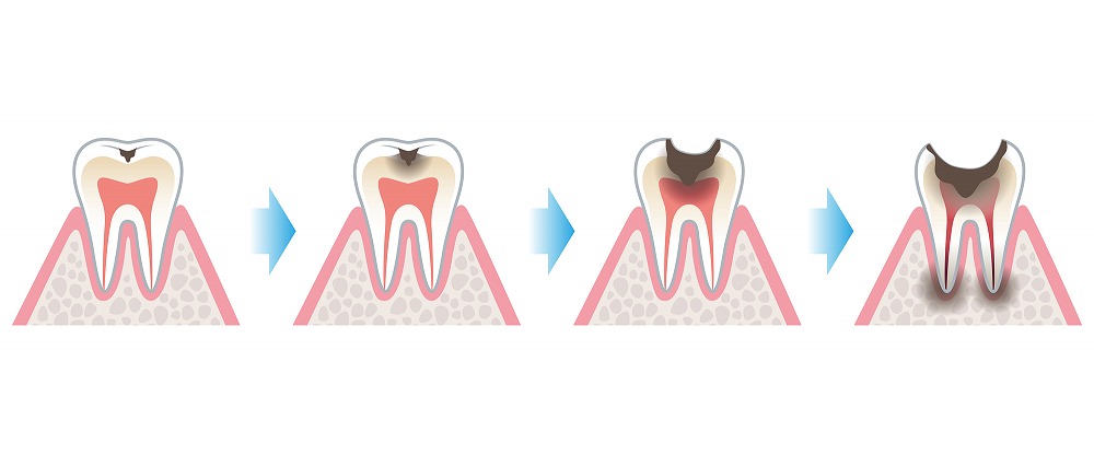 深い虫歯と浅い虫歯の違い